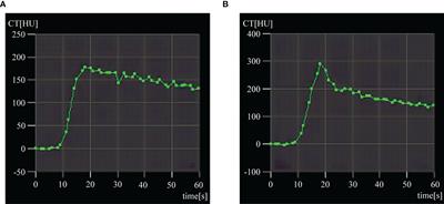 Early Assessment of Response to Radiofrequency Ablation With CT Perfusion Imaging in Rabbit VX2 Liver Tumor Model